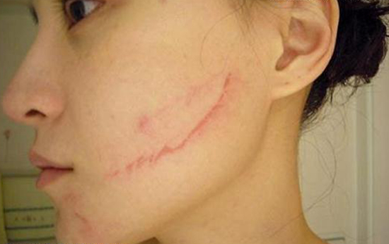 啤酒瓶爆炸，女服務(wù)員臉上留疤，餐廳和啤酒經(jīng)銷商都拒賠