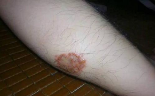 廚師小腿被蚊子叮潰爛 1年不愈合，竟是職業(yè)病引起的